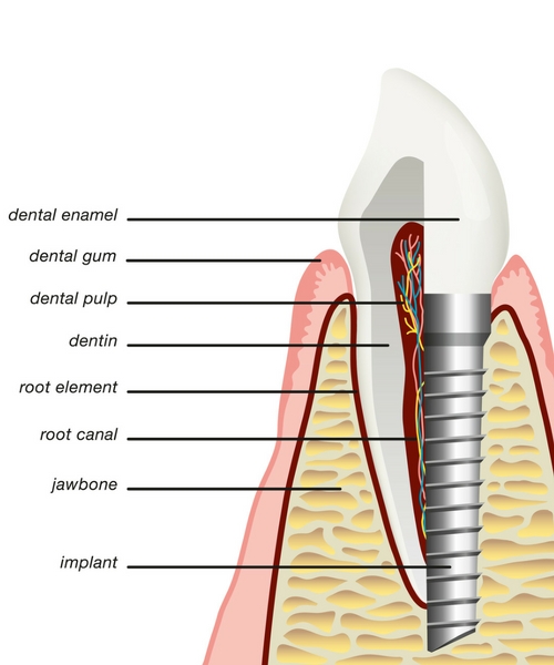 dental implants shreveport