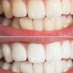 natural teeth whitening