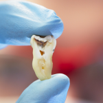 how-do-i-know-if-i-need-a-tooth-pulled