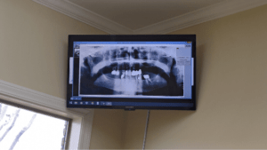 How often should I get dental x-ray - shreveport's dentist
